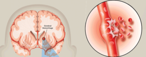 Failed to Identify Stroke NJ legal help near me 