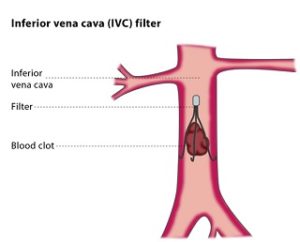 New Jersey IVC Filter Lawyer