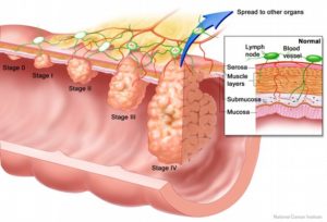 NJ Colon Cancer Misdiagnosis Lawyers