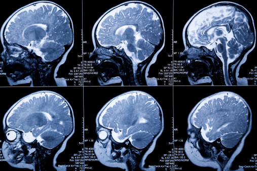 What Is Hypoxic-Ischemic Encephalopathy (HIE)?