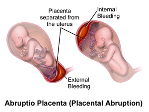 NJ Placental Abruption Lawyer