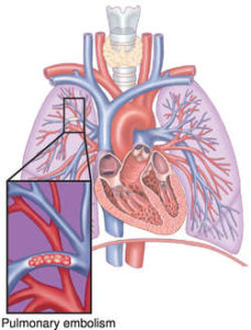 New Jersey Pulmonary Embolism Malpractice Lawyers