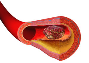 DVT Misdiagnosis in New Jersey