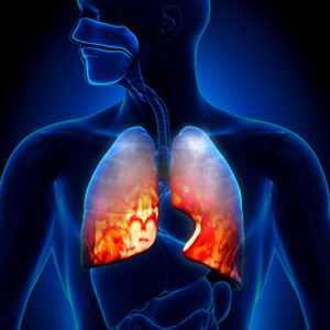 Pneumonia malpractice in NJ